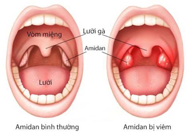 Viêm amidan là một trong những bệnh tai mũi họng thường gặp