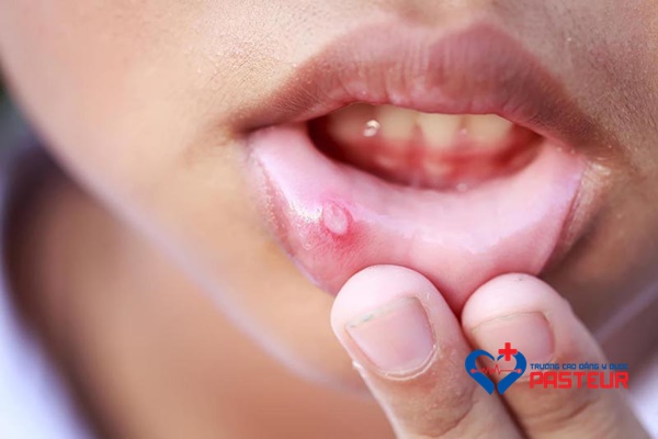 Bài thuốc trị nhiệt miệng cần áp dụng đúng cách khi bị bệnh