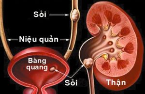 Bài thuốc Đông Y trị sỏi tiết niệu hiệu quả